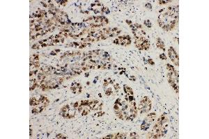 Anti-MCM2 antibody, IHC(P) IHC(P): Human Lung Cancer Tissue (MCM2 antibody  (C-Term))