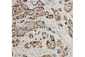 Anti-MCM2 antibody, IHC(P) IHC(P): Human Lung Cancer Tissue