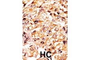Formalin-fixed and paraffin-embedded human cancer tissue reacted with the primary antibody, which was peroxidase-conjugated to the secondary antibody, followed by AEC staining. (p107 antibody  (pSer975))