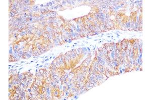 Immunohistochemistry of paraffin-embedded human colon carcinoma using Cyclophilin 40 Rabbit mAb (ABIN7269213) at dilution of 1:100 (40x lens). (PPID antibody)