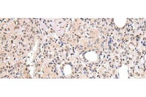 Immunohistochemistry of paraffin-embedded Human thyroid cancer using CBX7 Polyclonal Antibody at dilution of 1/20 (CBX7 antibody)