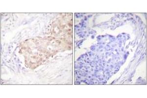 Immunohistochemistry analysis of paraffin-embedded human breast carcinoma tissue, using EDD Antibody. (UBR5 antibody  (AA 1-50))