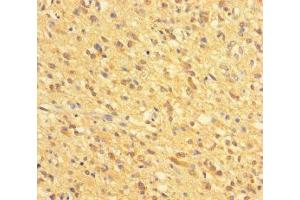 Immunohistochemistry of paraffin-embedded human glioma using ABIN7154018 at dilution of 1:100 (GATD3A (AA 43-268) antibody)