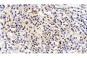 Detection of IL5Ra in Human Stomach cancer Tissue using Polyclonal Antibody to Interleukin 5 Receptor Alpha (IL5Ra) (IL5RA antibody  (AA 42-182))