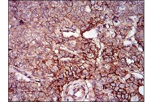 Immunohistochemical analysis of paraffin-embedded prostate cancer tissues using mSplunc2 mouse mAb with DAB staining.
