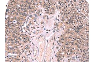 The image on the left is immunohistochemistry of paraffin-embedded Human ovarian cancer tissue using ABIN7190608(EXTL1 Antibody) at dilution 1/20, on the right is treated with synthetic peptide. (EXTL1 antibody)