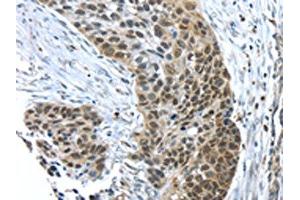 The image on the left is immunohistochemistry of paraffin-embedded Human esophagus cancer tissue using (TKTL1 Antibody) at dilution 1/40, on the right is treated with fusion protein. (TKTL1 antibody)