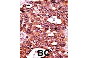Formalin-fixed and paraffin-embedded human cancer tissue reacted with CDC6 (phospho S54) polyclonal antibody  which was peroxidase-conjugated to the secondary antibody followed by AEC staining.