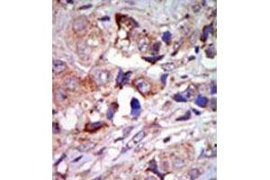 Formalin-fixed and paraffin-embedded human cancer tissue (breast carcinoma) reacted with the primary antibody, which was peroxidase-conjugated to the secondary antibody, followed by AEC staining. (MAP3K12 antibody  (C-Term))