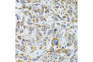 Immunohistochemistry of paraffin-embedded human liver cancer using RPN1 antibody. (RPN1 antibody  (AA 20-280))
