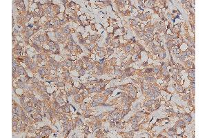 ABIN6269036 at 1/200 staining human breast cancer tissue sections by IHC-P.