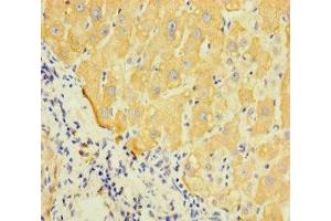 Immunohistochemistry of paraffin-embedded human liver cancer using ABIN7158796 at dilution of 1:100 (LAPTM5 antibody  (AA 205-262))