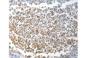 Immunohistochemical analysis of paraffin-embedded Human liver cancer tissue using at dilution 1/40. (CHD5 antibody  (C-Term))