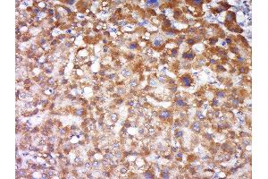 Formalin-fixed and paraffin embedded human liver carcinoma labeled with Anti-FAIM3 Polyclonal Antibody, Unconjugated  at 1:500 followed by conjugation to the secondary antibody and DAB staining. (FAIM3 antibody  (AA 51-150))