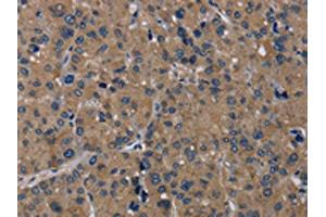The image on the left is immunohistochemistry of paraffin-embedded Human liver cancer tissue using ABIN7192919(TRPM1 Antibody) at dilution 1/20, on the right is treated with synthetic peptide.