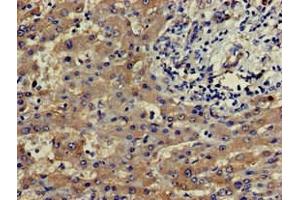 Immunohistochemistry of paraffin-embedded human liver cancer using ABIN7164181 at dilution of 1:100