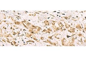 Immunohistochemistry of paraffin-embedded Human gastric cancer tissue using PDS5A Polyclonal Antibody at dilution of 1:90(x200) (PDS5A antibody)
