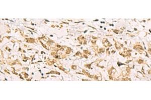 Immunohistochemistry of paraffin-embedded Human gastric cancer tissue using PDS5A Polyclonal Antibody at dilution of 1:90(x200) (PDS5A antibody)