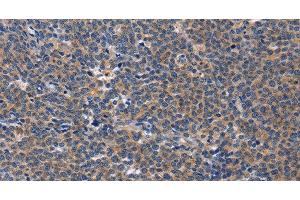 Immunohistochemistry of paraffin-embedded Human Lymphoma tissue using CD5L Polyclonal Antibody at dilution 1:40 (CD5L antibody)