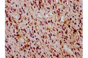 IHC image of ABIN7127707 diluted at 1:100 and staining in paraffin-embedded human glioma cancer performed on a Leica BondTM system. (Recombinant ERK1 antibody  (pThr185, pThr202))