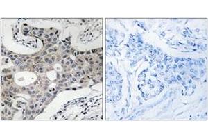 Immunohistochemistry analysis of paraffin-embedded human breast carcinoma, using SEC16A Antibody. (SEC16A antibody  (AA 1013-1062))