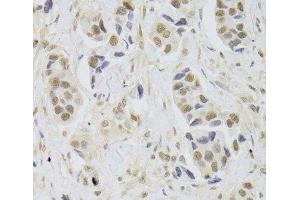 Immunohistochemistry of paraffin-embedded Human breast cancer using UBE3C Polyclonal Antibody at dilution of 1:100 (40x lens). (UBE3C antibody)