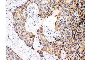 Anti-Caspase-12 antibody, IHC(P) IHC(P): Human Mammary Cancer Tissue (Caspase 12 antibody  (N-Term))