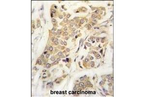 Formalin-fixed and paraffin-embedded human breast carcinoma tissue reacted with CDH8 antibody (N-term) (ABIN388149 and ABIN2846895) , which was peroxidase-conjugated to the secondary antibody, followed by DAB staining. (Cadherin 8 antibody  (N-Term))