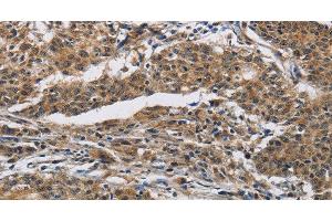 Immunohistochemistry of paraffin-embedded Human gastric cancer using IFNGR2 Polyclonal Antibody at dilution of 1:40 (IFNGR2 antibody)