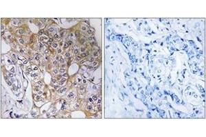 Immunohistochemistry analysis of paraffin-embedded human breast carcinoma tissue, using CCT6A Antibody. (CCT6A antibody  (AA 171-220))