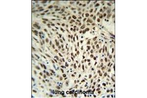 SNRPD3 Antibody (C-term) (ABIN653228 and ABIN2842762) IHC analysis in formalin fixed and paraffin embedded human lung carcinoma followed by peroxidase conjugation of the secondary antibody and DAB staining. (SNRPD3 antibody  (C-Term))