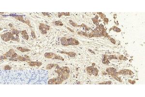 Immunohistochemistry of paraffin-embedded Human liver cancer tissue using CK-19 Polyclonal Antibody at dilution of 1:200. (Cytokeratin 19 antibody)