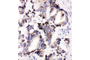 Anti-IRAK2 antibody, IHC(P) IHC(P): Human Lung Cancer Tissue (IRAK2 antibody  (C-Term))