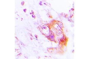 Immunohistochemical analysis of PKR (pT451) staining in human lung cancer formalin fixed paraffin embedded tissue section. (EIF2AK2 antibody  (C-Term, pSer451))