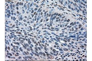 Immunohistochemical staining of paraffin-embedded Adenocarcinoma of breast tissue using anti-MAPK1 mouse monoclonal antibody. (ERK2 antibody)