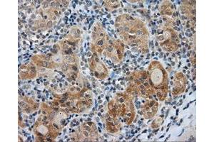 Immunohistochemical staining of paraffin-embedded Adenocarcinoma of colon tissue using anti-LIPG mouse monoclonal antibody. (LIPG antibody)