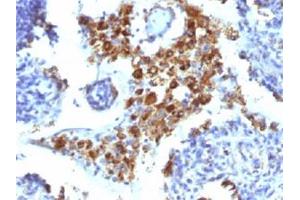 Immunohistochemical staining (Formalin-fixed paraffin-embedded sections) of human lung adenocarcinoma with NAPSA monoclonal antibody, clone NAPSA/1238 .