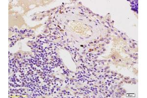 Formalin-fixed and paraffin embedded human lung carcinoma labeled with Anti-AIMP2 Polyclonal Antibody, Unconjugated (ABIN741300) at 1:200, followed by conjugation to the secondary antibody and DAB staining (AIMP2 antibody  (AA 201-300))