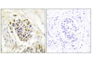 Immunohistochemistry analysis of paraffin-embedded human breast carcinoma tissue using MED1 antibody. (MED1 antibody  (Internal Region))