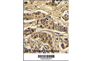 Formalin-fixed and paraffin-embedded human breast carcinoma reacted with NCS1 Antibody , which was peroxidase-conjugated to the secondary antibody, followed by DAB staining. (NCS1 antibody  (AA 118-144))