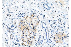 ABIN6257207 and ABIN6275954 at 1/100 staining Human pancreatic cancer by IHC-P. (G Protein-Coupled Receptor 119 antibody  (Internal Region))