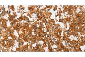 Immunohistochemistry of paraffin-embedded Human thyroid cancer using cPLA2 Polyclonal Antibody at dilution of 1:50 (PLA2G4A antibody)