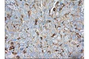 Immunohistochemical staining of paraffin-embedded Adenocarcinoma of colon tissue using anti-ALDH3A1 mouse monoclonal antibody. (ALDH3A1 antibody)