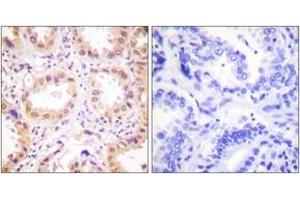 Immunohistochemistry analysis of paraffin-embedded human lung carcinoma tissue, using NEDD8 Antibody.