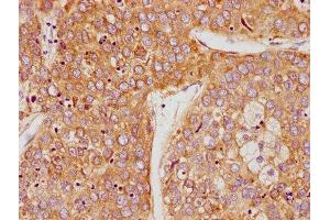 IHC image of ABIN7164243 diluted at 1:100 and staining in paraffin-embedded human liver cancer performed on a Leica BondTM system. (PSG9 antibody  (AA 241-426))