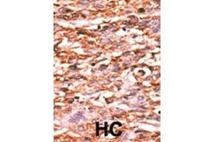 Formalin-fixed and paraffin-embedded human cancer tissue reacted with the primary antibody, which was peroxidase-conjugated to the secondary antibody, followed by AEC staining. (VEGFR2/CD309 antibody  (pTyr996))