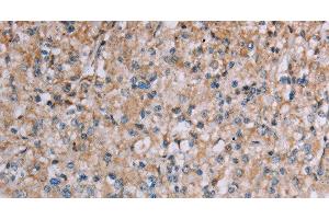 Immunohistochemistry of paraffin-embedded Human prostate cancer tissue using PLXNA4 Polyclonal Antibody at dilution 1:50 (Plexin A4 antibody)