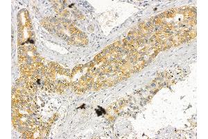 BAT3 Mouse Monoclonal Antibody at 1/100 staining human lung cancer by IHC-P.