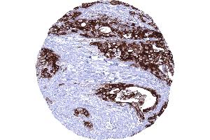 Muscle invasive urothelial carcinoma of the urinary bladder showing a strong Upk1b immunostaining of tumor cells (Uroplakin 1B antibody  (AA 109-229))