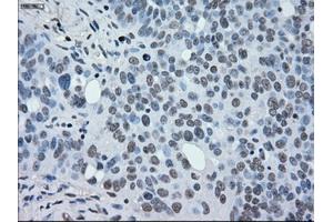 Immunohistochemical staining of paraffin-embedded Adenocarcinoma of breast tissue using anti-MAP2K2 mouse monoclonal antibody. (MEK2 antibody)